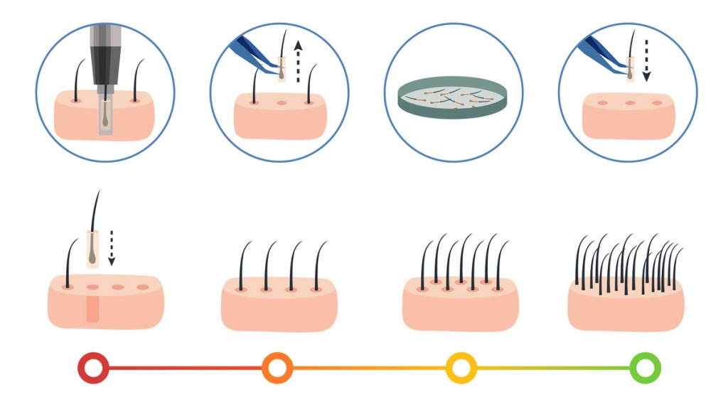 Hair Transplant