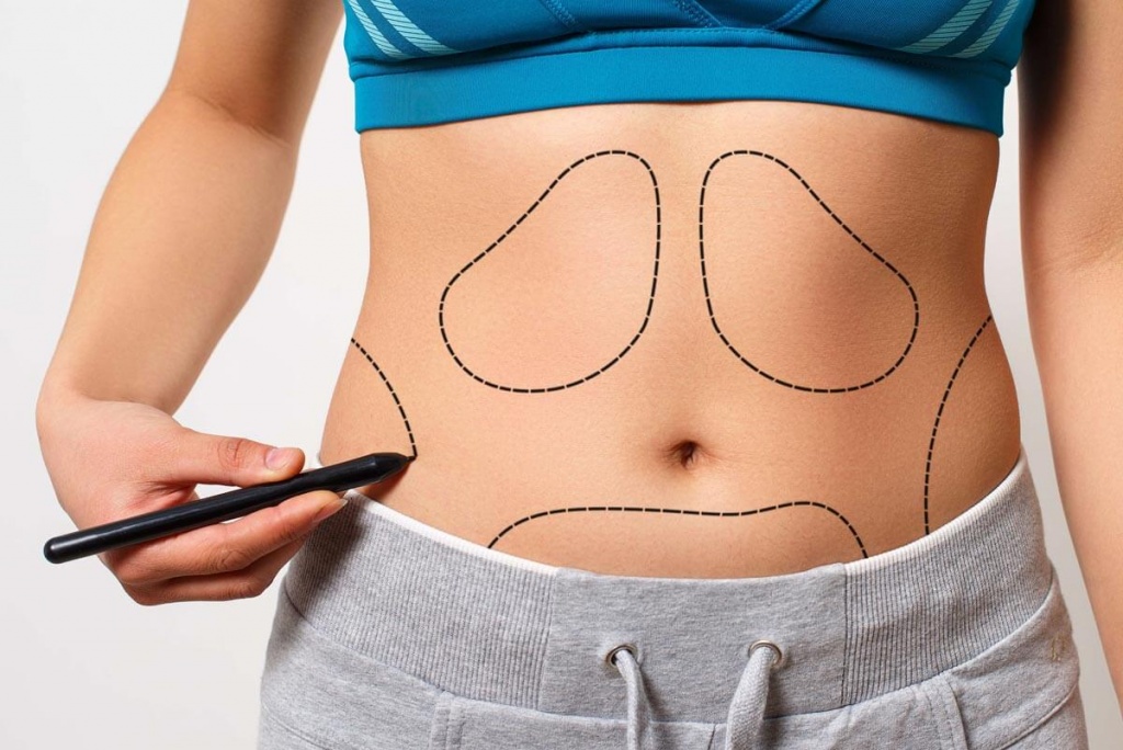 Liposuction