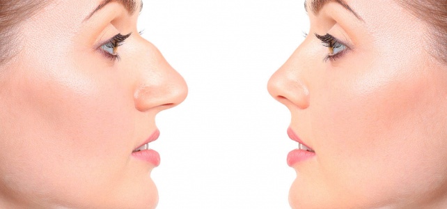 Rhinoplasty